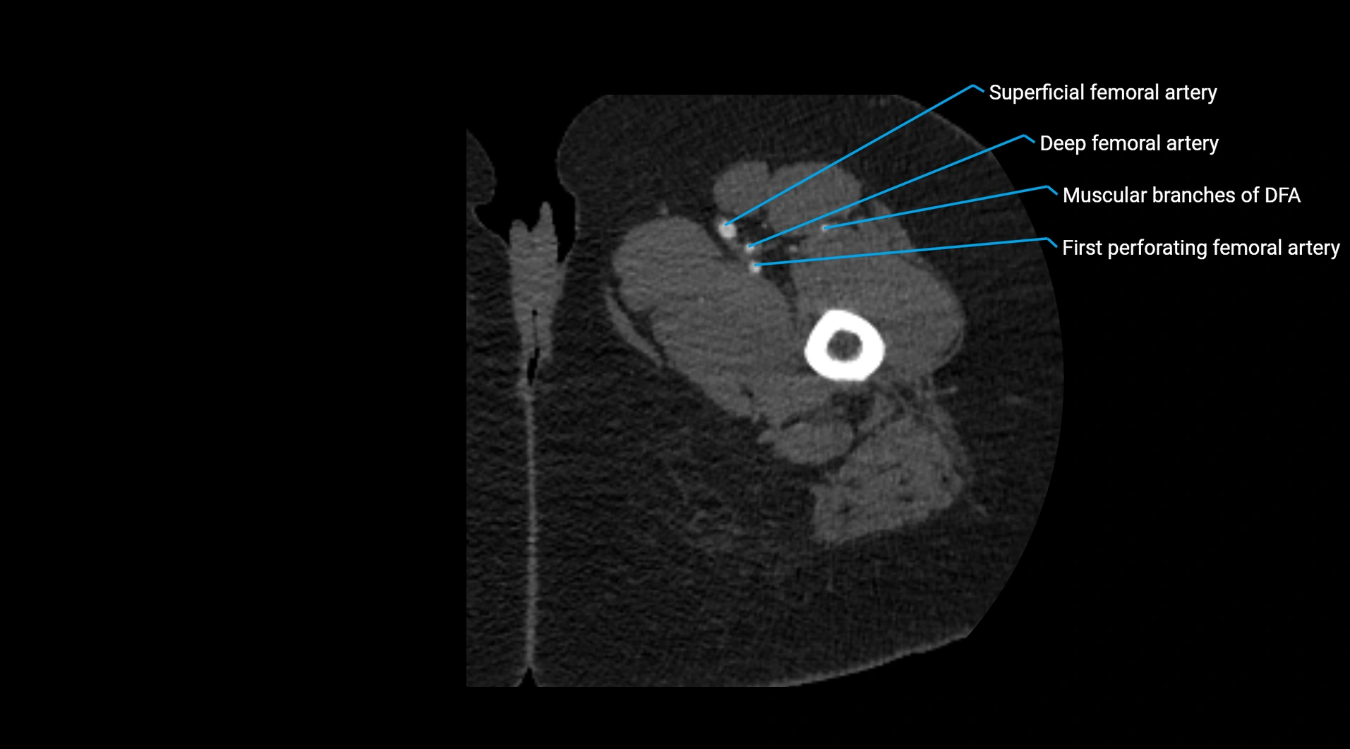 CTA lower limb cross sectional anatomy labelled image _86.webp